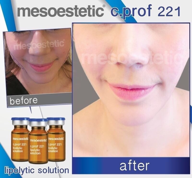 ٻҾ2 ͧԹ : lipolytic 221/  mesoestetic c.prof 221 /