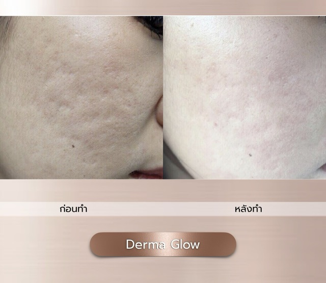 ٻҾ2 ͧԹ : Derma Glow 